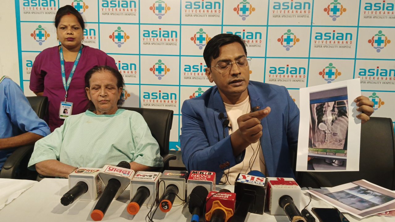 एशियन विवेकानंद अस्पताल में एकेलेसिया कार्डिया जैसी खतरनाक बीमारी का सफल ऑपरेशन PER ORAL ENDOSCOPY MAYOTOMY (POEM )  किया गया
